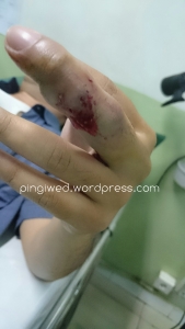 luka dibagian luar jari