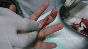 luka bagian dalam jari